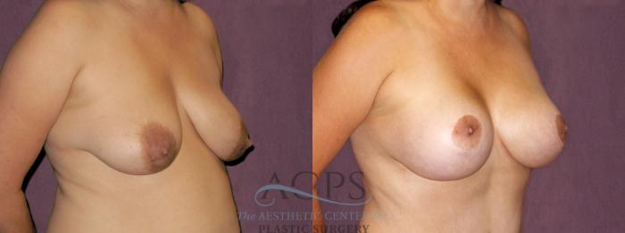 Before & After Breast Lift Case 1118 Oblique Right View: View in Houston, TX