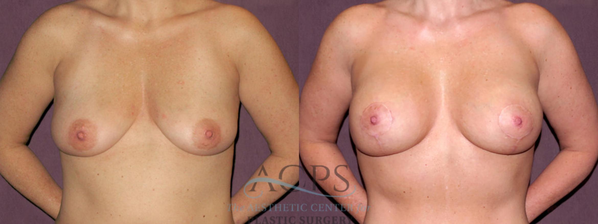 Before & After Breast Lift Case 1119 Front View: View in Houston, TX