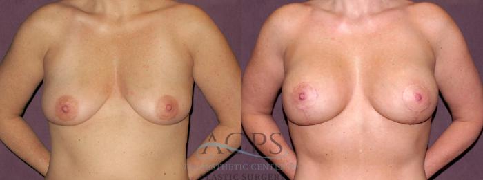 Before & After Breast Lift Case 1119 Front View: View in Houston, TX