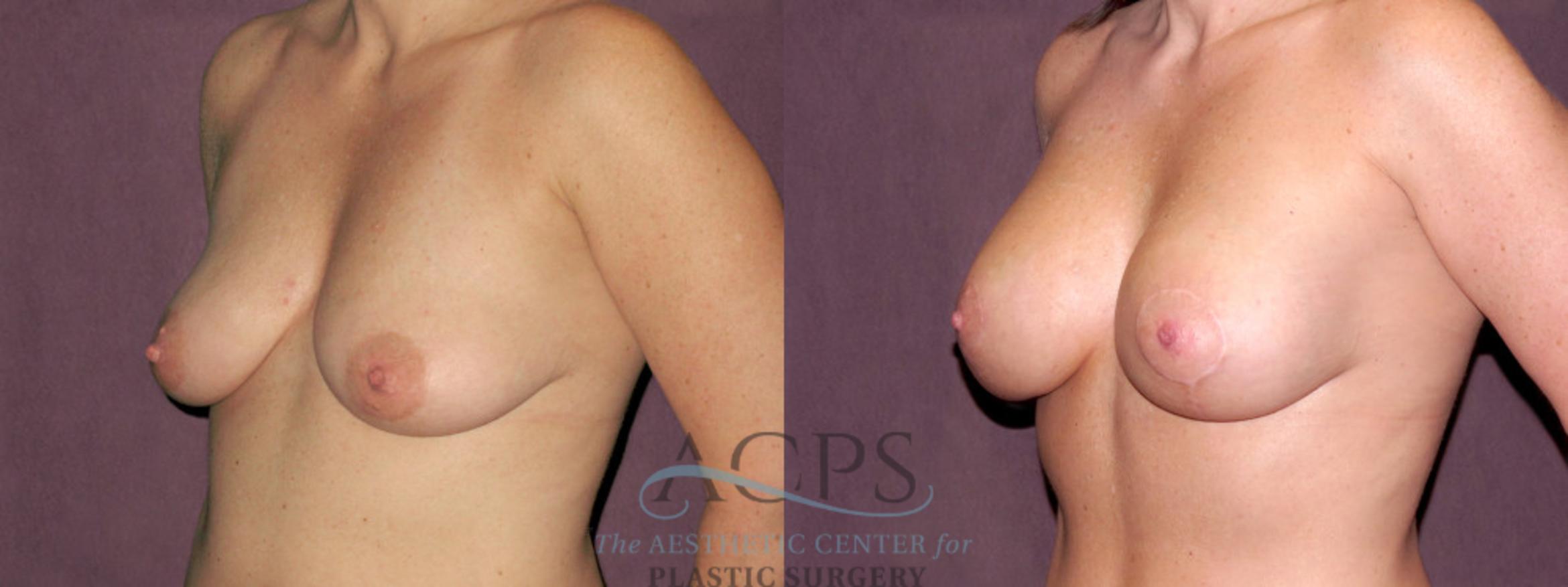 Before & After Breast Lift Case 1119 Oblique Left View: View in Houston, TX