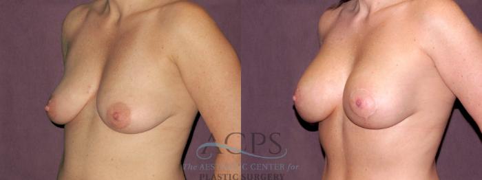 Before & After Breast Lift Case 1119 Oblique Left View: View in Houston, TX
