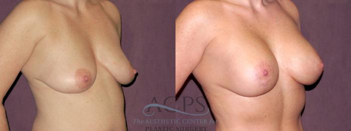 Before & After Breast Lift Case 1119 Oblique Right View: View in Houston, TX