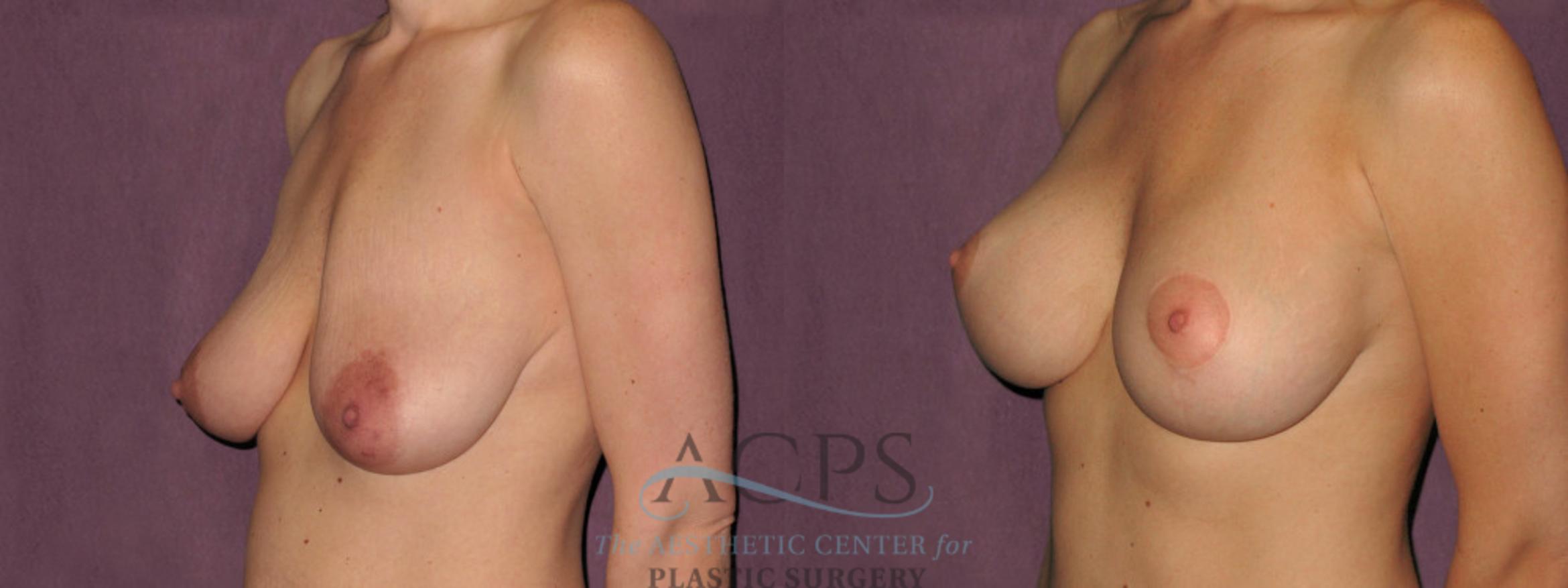 Before & After Breast Lift Case 1120 Oblique Left View: View in Houston, TX