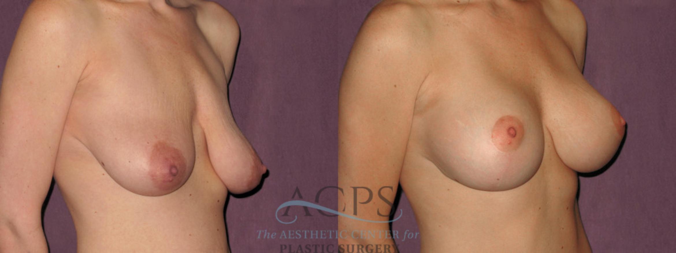 Before & After Breast Lift Case 1120 Oblique Right View: View in Houston, TX