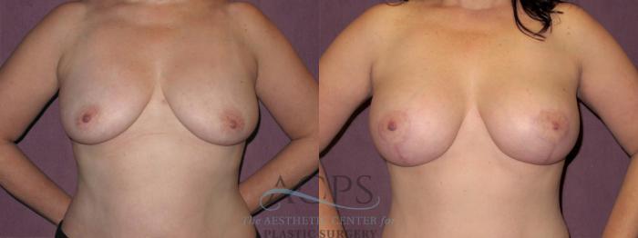 Before & After Breast Lift Case 1121 Front View: View in Houston, TX