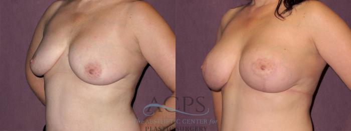 Before & After Breast Lift Case 1121 Oblique Left View: View in Houston, TX