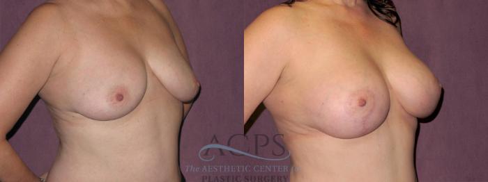 Before & After Breast Lift Case 1121 Oblique Right View: View in Houston, TX