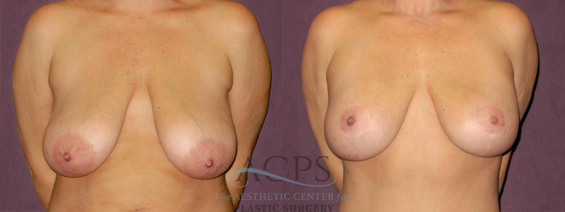 Before & After Breast Lift Case 1122 Front View: View in Houston, TX