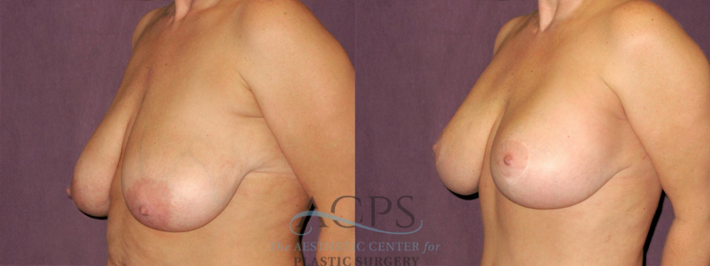 Before & After Breast Lift Case 1122 Oblique Left View: View in Houston, TX