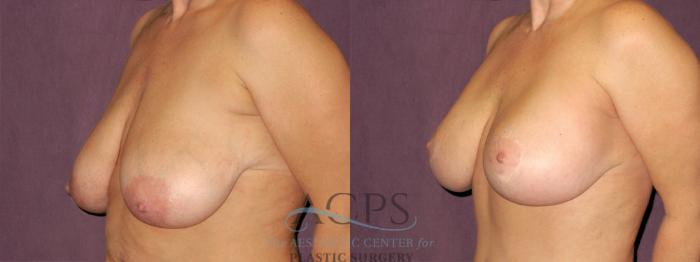 Before & After Breast Lift Case 1122 Oblique Left View: View in Houston, TX