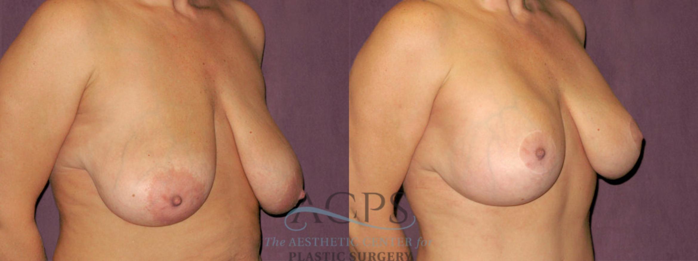Before & After Breast Lift Case 1122 Oblique Right View: View in Houston, TX