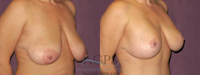 Before & After Breast Lift Case 1122 Oblique Right View: View in Houston, TX