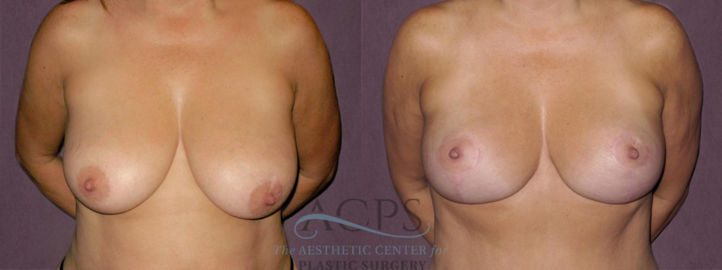 Before & After Breast Lift Case 1123 Front View: View in Houston, TX