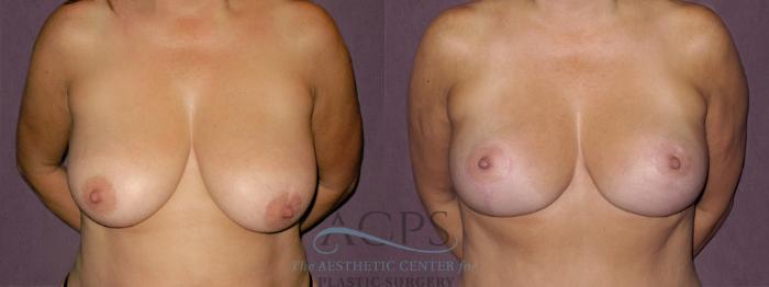 Before & After Breast Lift Case 1123 Front View: View in Houston, TX