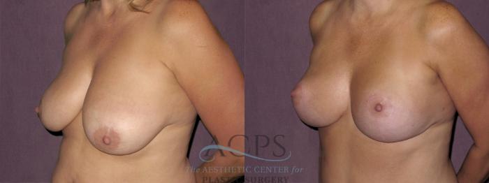 Before & After Breast Lift Case 1123 Oblique Left View: View in Houston, TX