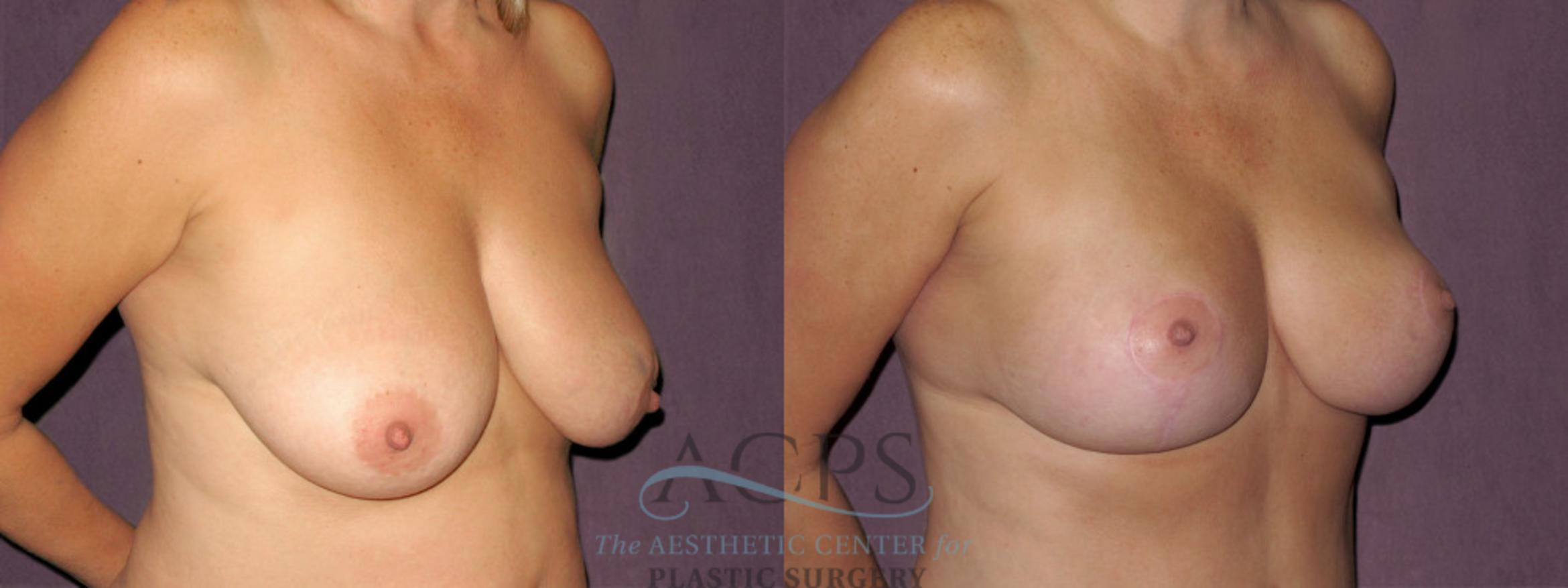 Before & After Breast Lift Case 1123 Oblique Right View: View in Houston, TX