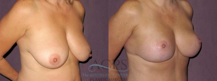 Before & After Breast Lift Case 1123 Oblique Right View: View in Houston, TX