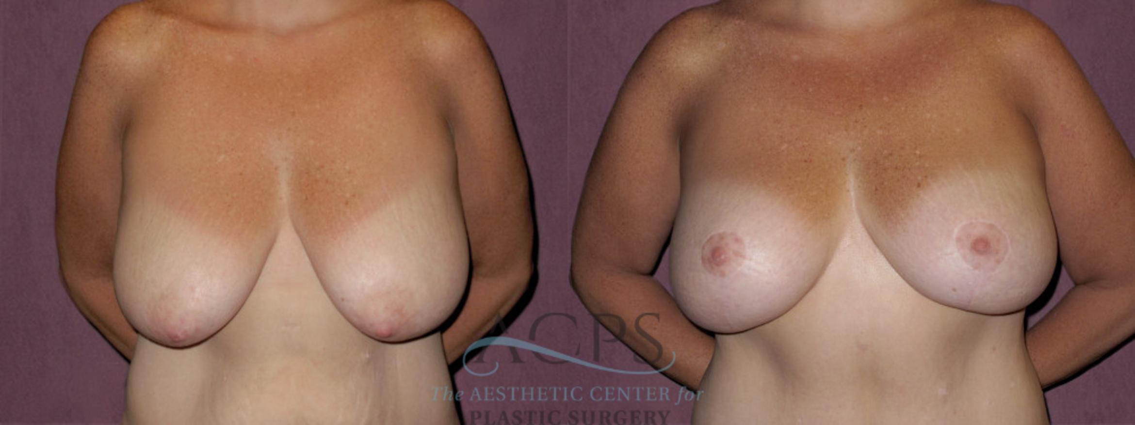Before & After Breast Lift Case 1127 Front View: View in Houston, TX
