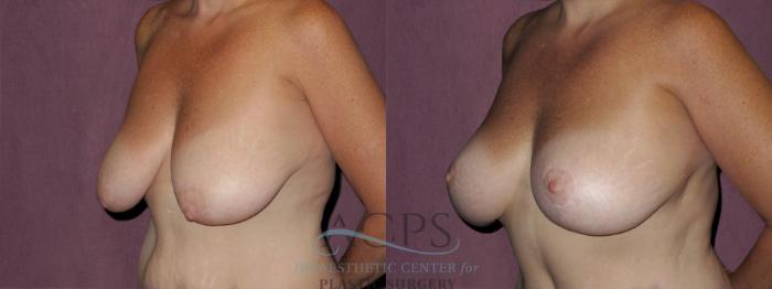 Before & After Breast Lift Case 1127 Oblique Left View: View in Houston, TX