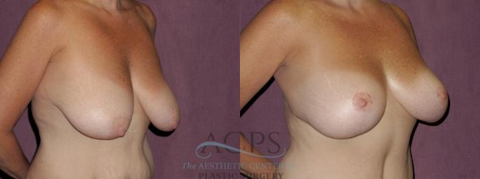 Before & After Breast Lift Case 1127 Oblique Right View: View in Houston, TX