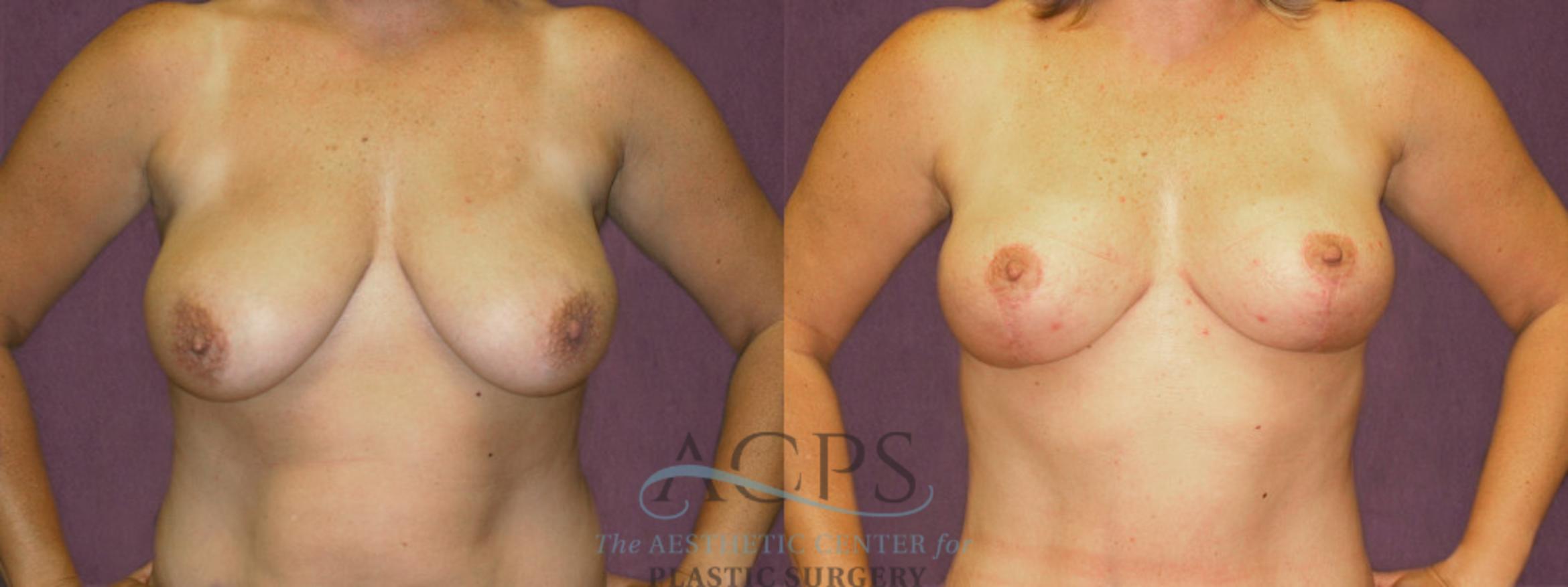 Before & After Breast Lift Case 1132 Front View: View in Houston, TX