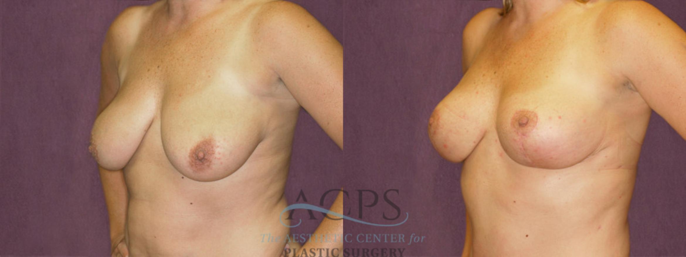 Before & After Breast Lift Case 1132 Oblique Left View: View in Houston, TX