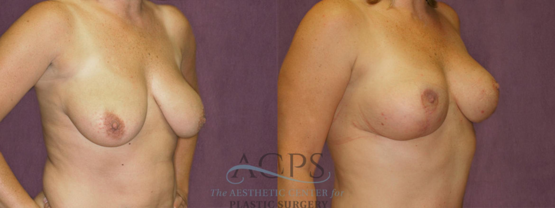 Before & After Breast Lift Case 1132 Oblique Right View: View in Houston, TX