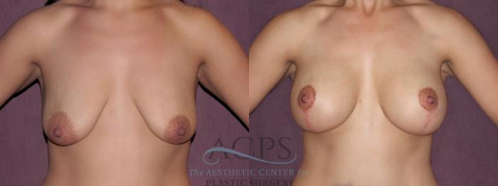 Before & After Breast Lift Case 1133 Front View: View in Houston, TX