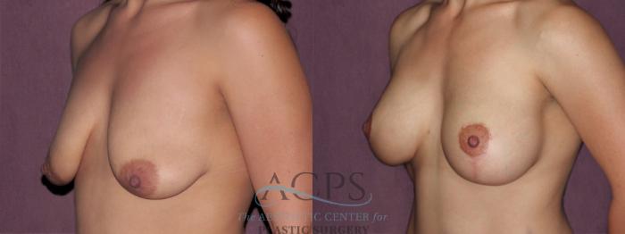Before & After Breast Lift Case 1133 Oblique Left View: View in Houston, TX