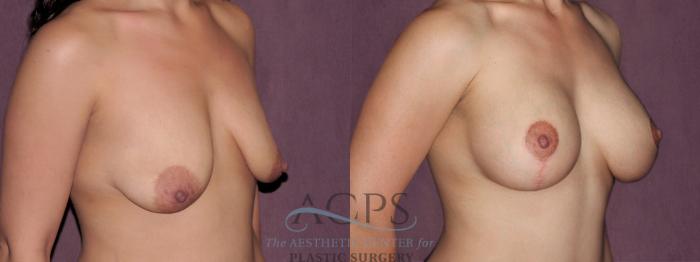 Before & After Breast Lift Case 1133 Oblique Right View: View in Houston, TX