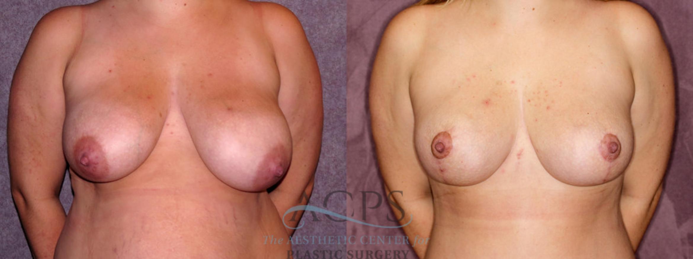 Before & After Breast Lift Case 1134 Front View: View in Houston, TX