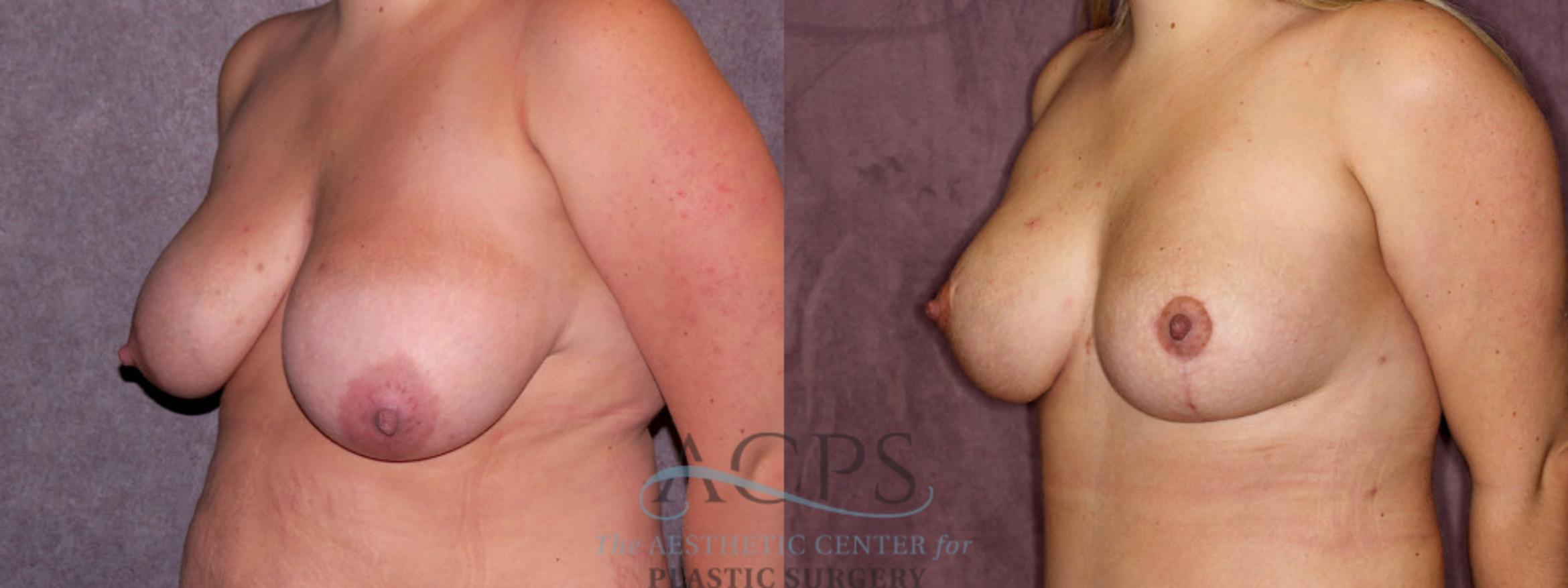 Before & After Breast Lift Case 1134 Oblique Left View: View in Houston, TX