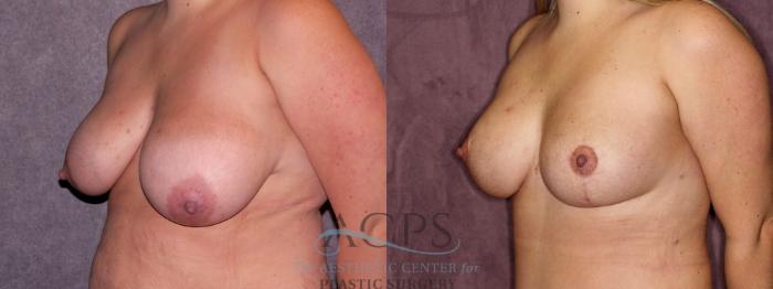 Before & After Breast Lift Case 1134 Oblique Left View: View in Houston, TX