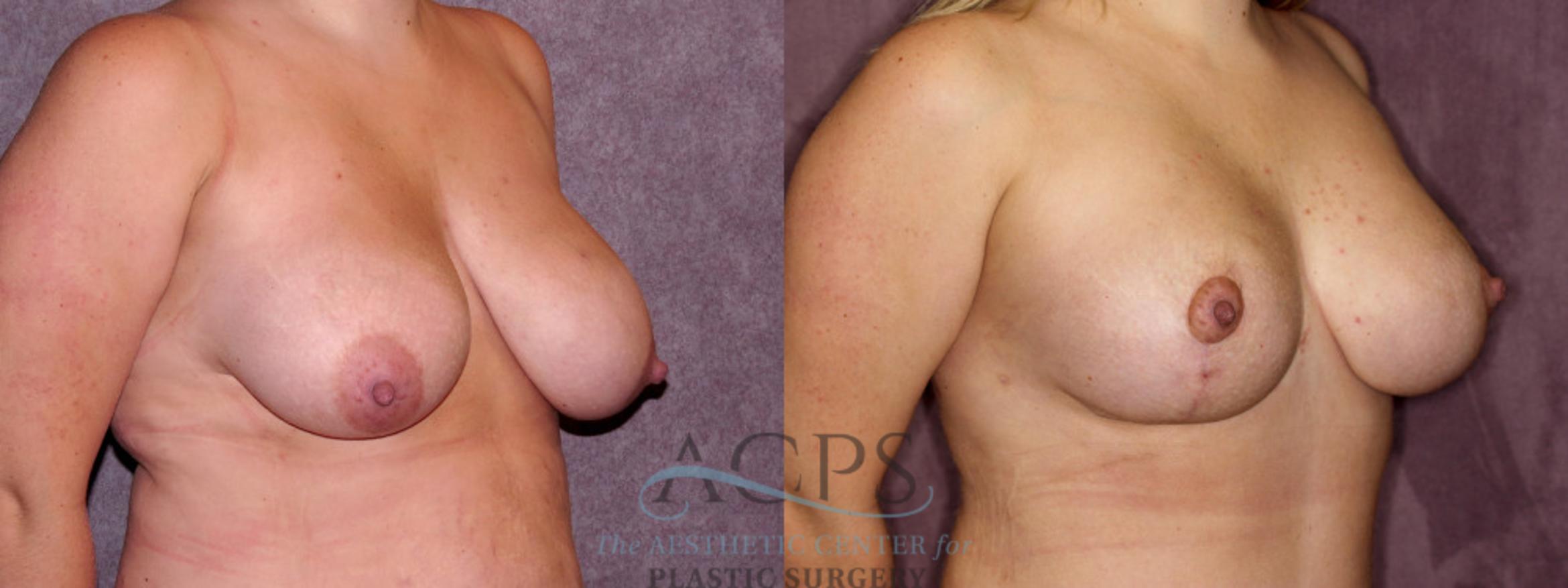 Before & After Breast Lift Case 1134 Oblique Right View: View in Houston, TX