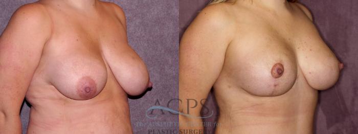 Before & After Breast Lift Case 1134 Oblique Right View: View in Houston, TX