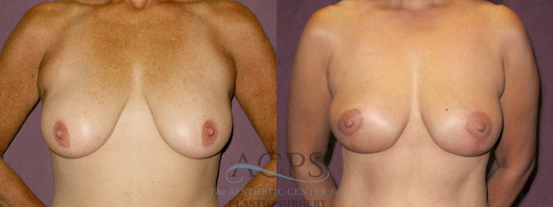 Before & After Breast Lift Case 1136 Front View: View in Houston, TX