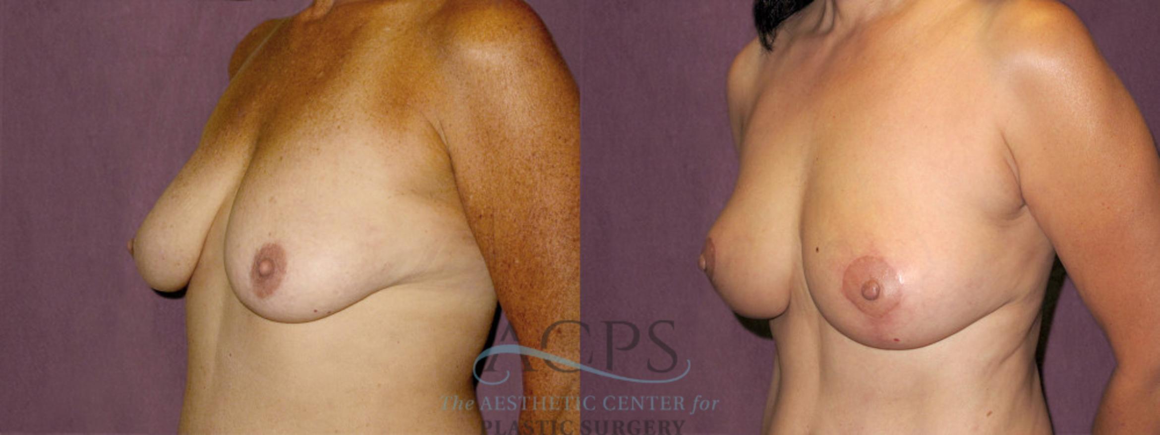 Before & After Breast Lift Case 1136 Oblique Left View: View in Houston, TX