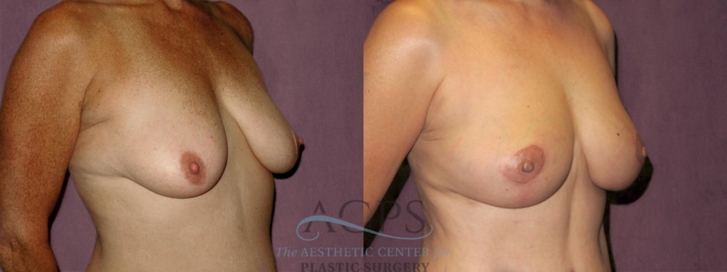 Before & After Breast Lift Case 1136 Oblique Right View: View in Houston, TX