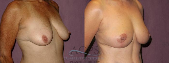Before & After Breast Lift Case 1136 Oblique Right View: View in Houston, TX