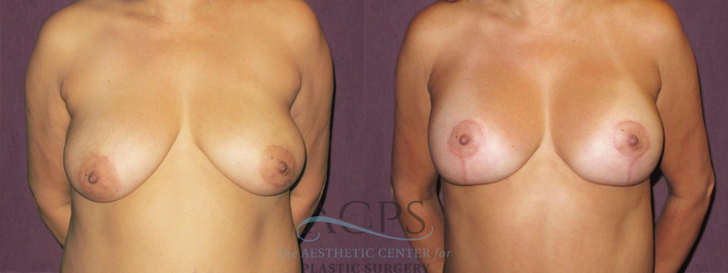 Before & After Breast Lift Case 1137 Front View: View in Houston, TX