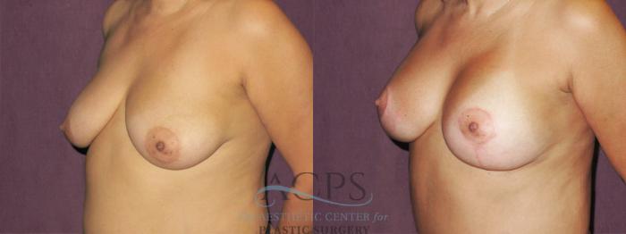 Before & After Breast Lift Case 1137 Oblique Left View: View in Houston, TX
