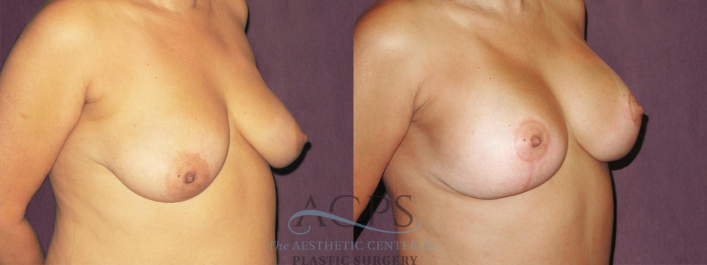 Before & After Breast Lift Case 1137 Oblique Right View: View in Houston, TX