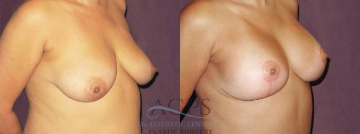 Before & After Breast Lift Case 1137 Oblique Right View: View in Houston, TX