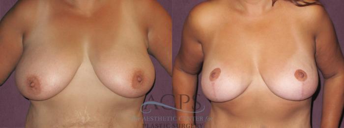 Before & After Breast Lift Case 1138 Front View: View in Houston, TX