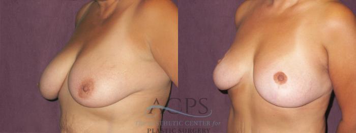Before & After Breast Lift Case 1138 Oblique Left View: View in Houston, TX