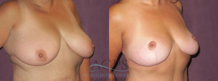 Before & After Breast Lift Case 1138 Oblique Right View: View in Houston, TX