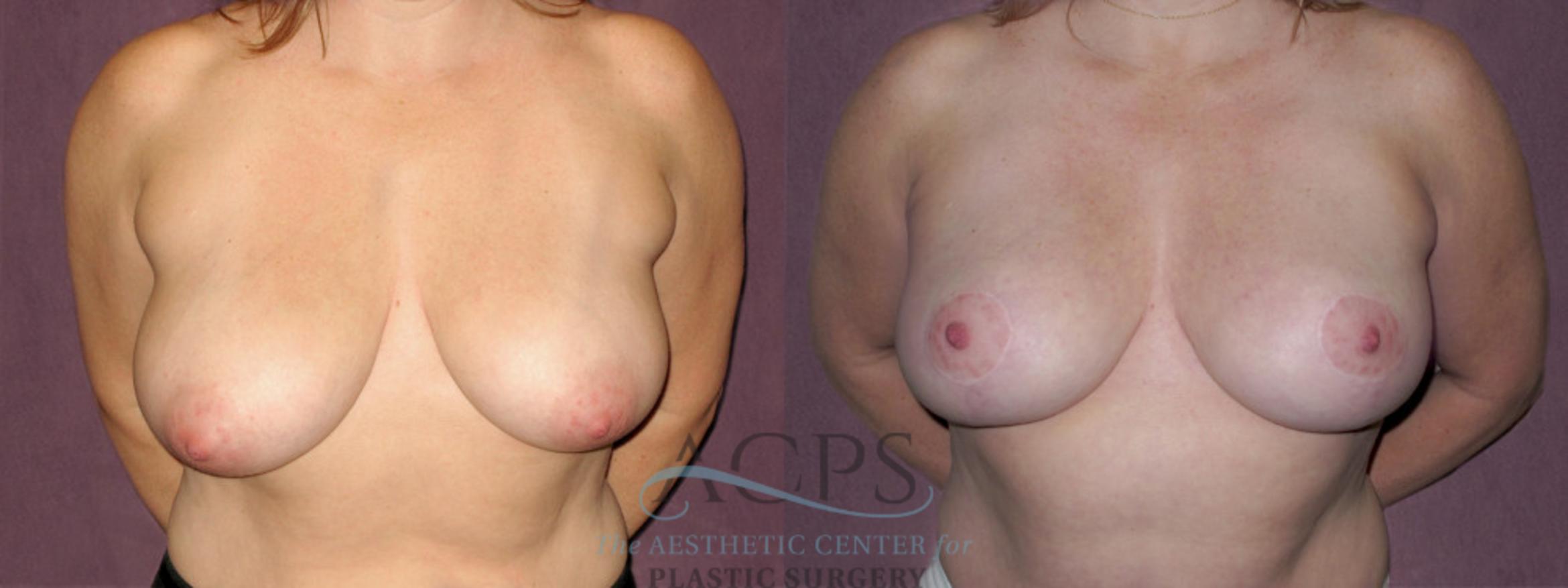 Before & After Breast Reduction Case 1139 Front View: View in Houston, TX