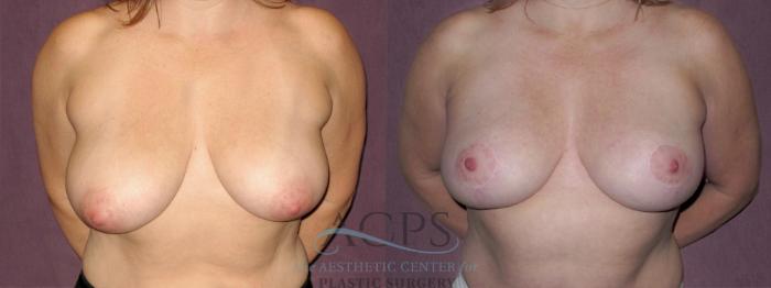 Before & After Breast Reduction Case 1139 Front View: View in Houston, TX