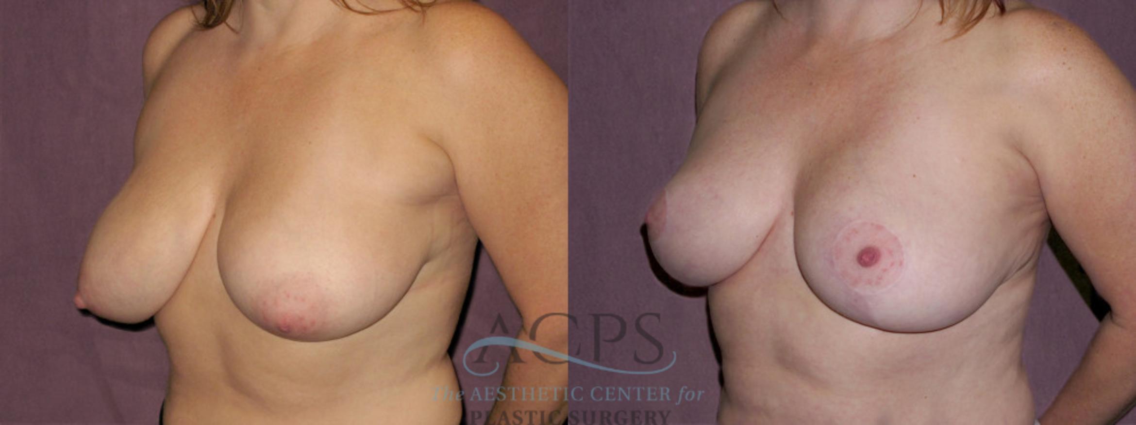 Before & After Breast Reduction Case 1139 Oblique Left View: View in Houston, TX