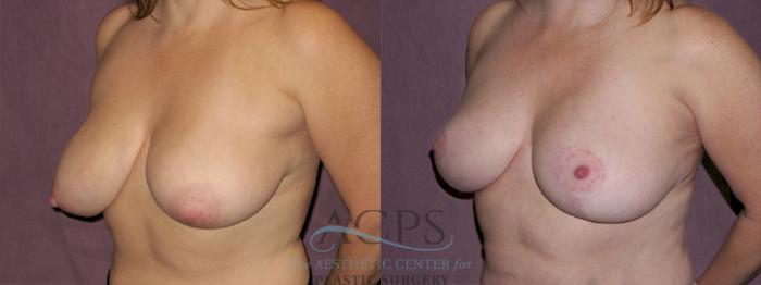 Before & After Breast Reduction Case 1139 Oblique Left View: View in Houston, TX